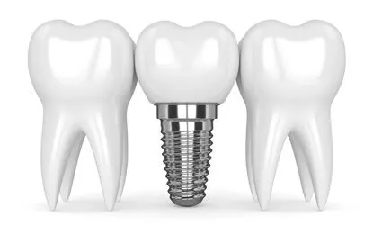 Implant Dentistry