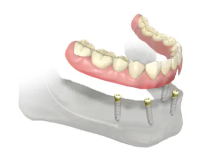 Denture