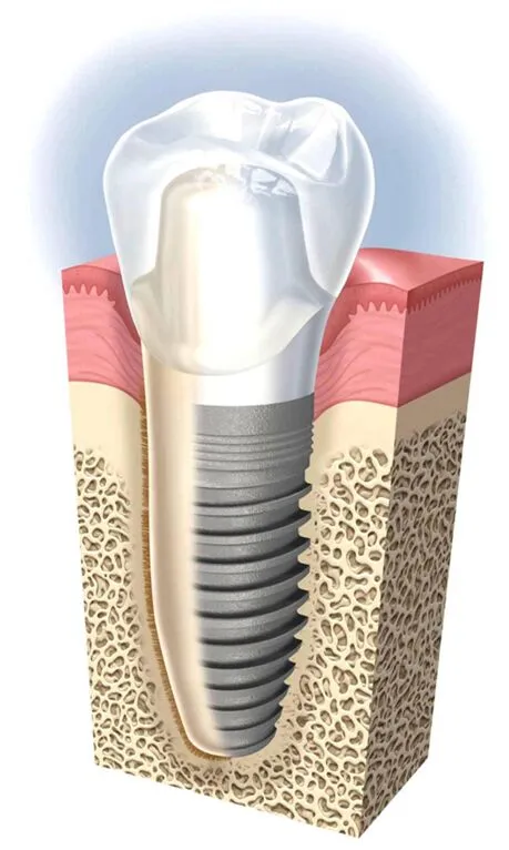 what-are-dental-implants