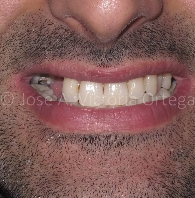 Gallery - Mandeep - 3 - Before