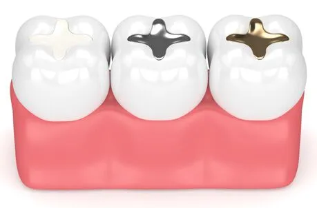Amalgam-Fillings