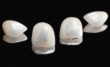 Benefits of veneers