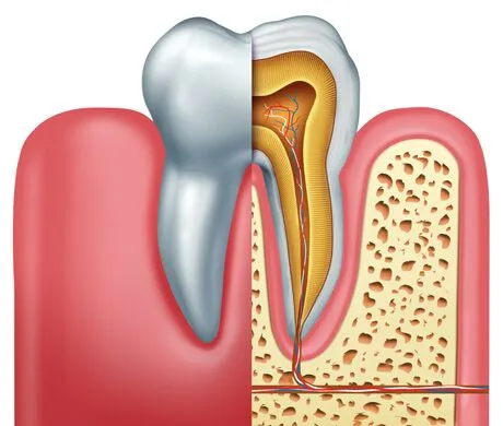 Root Canal Treatment
