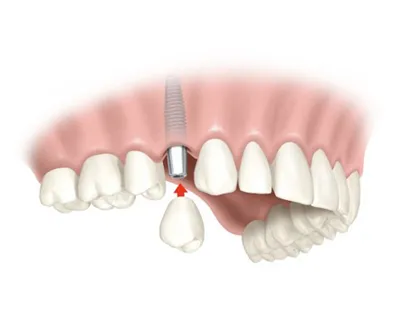 Single-Tooth
