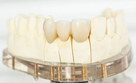 Crowns