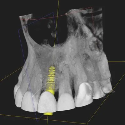 cbct